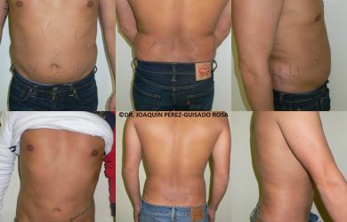 liposucción cordoba