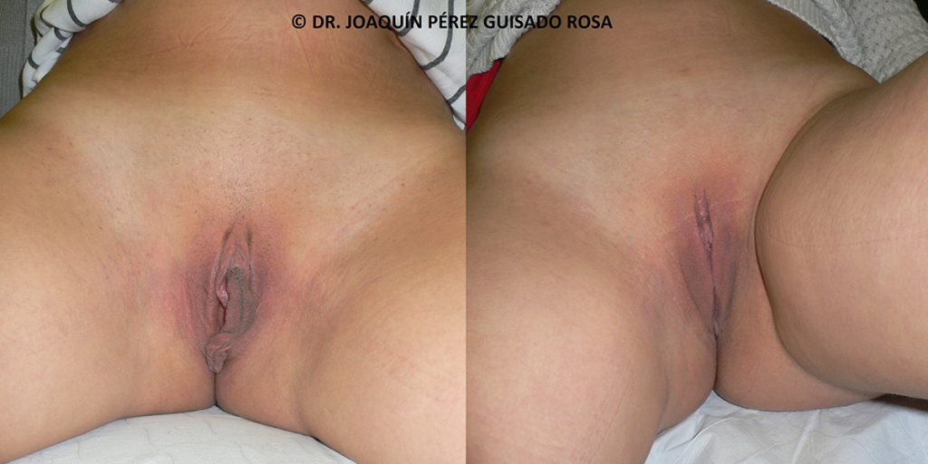 antes despues cirujia intima jaen