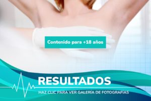 Resultados de cirugía en Aumentos de Pecho en España