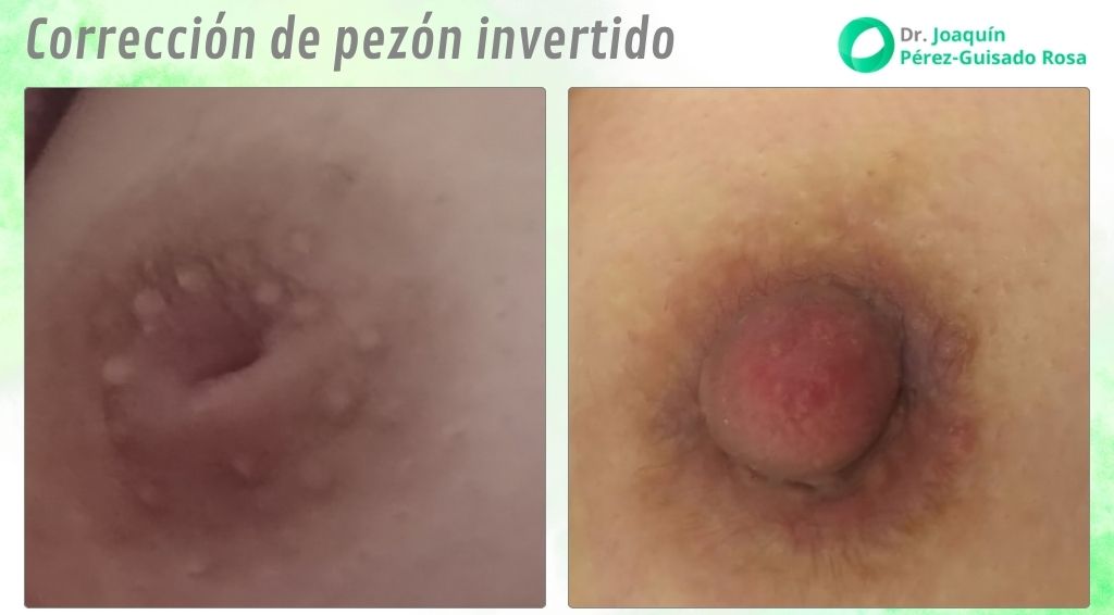 Corrección de pezón invertido Córdoba